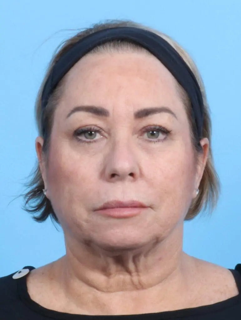 Eyelid Surgery - Case 23734 - Before