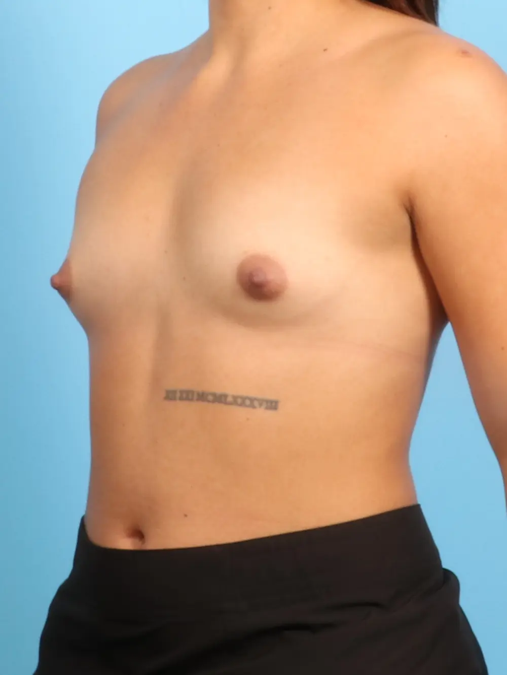 Breast Augmentation Patient Photo - Case 23762 - before view-1