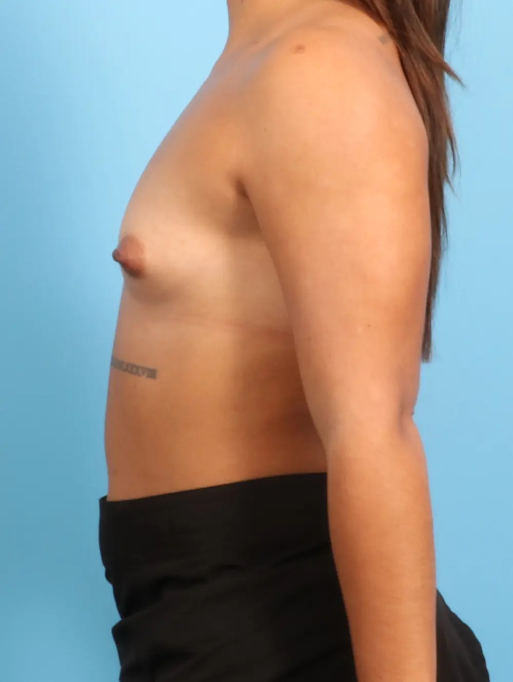 Breast Augmentation Patient Photo - Case 23762 - before view-2