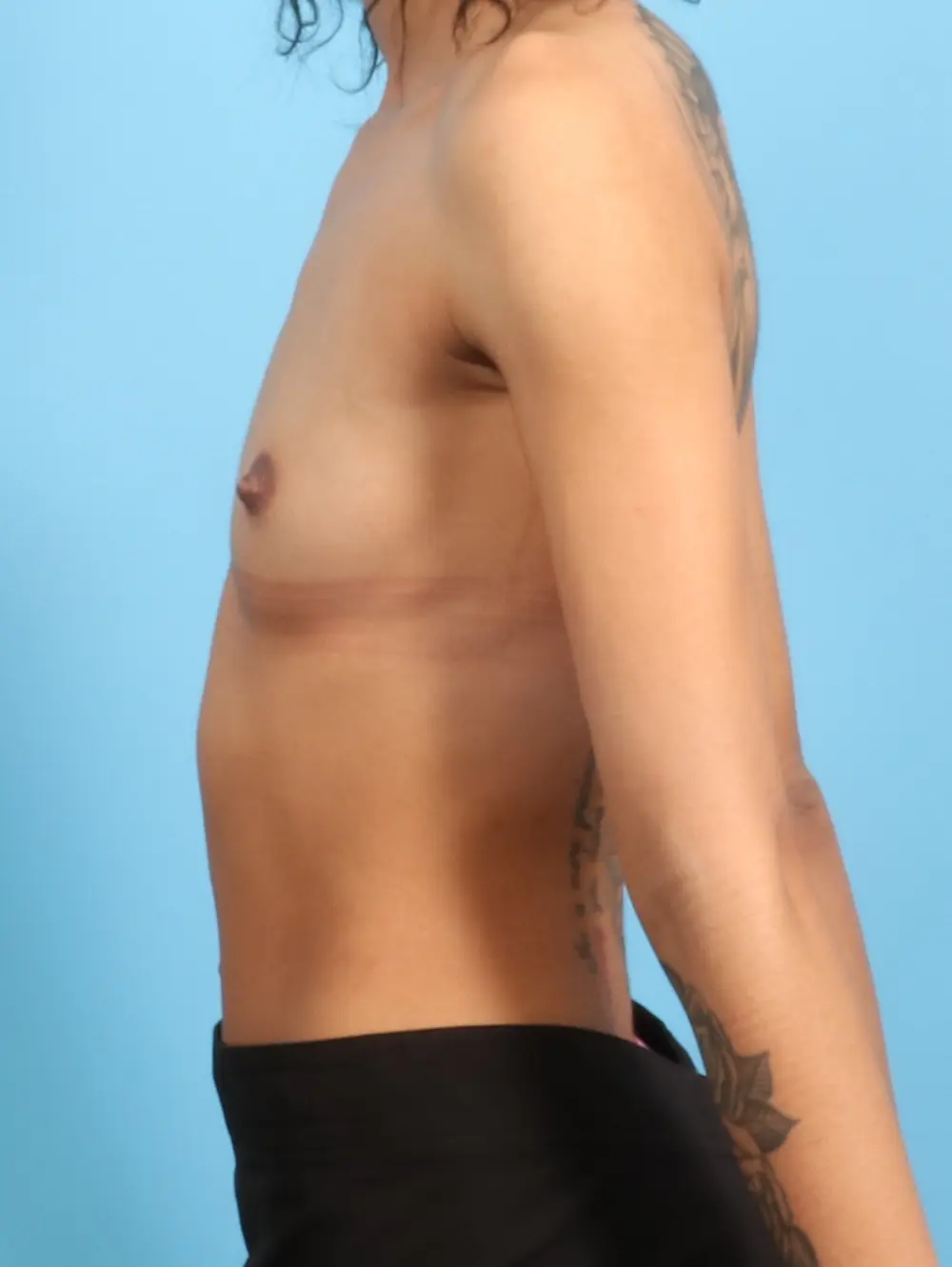 Breast Augmentation Patient Photo - Case 23786 - before view-2