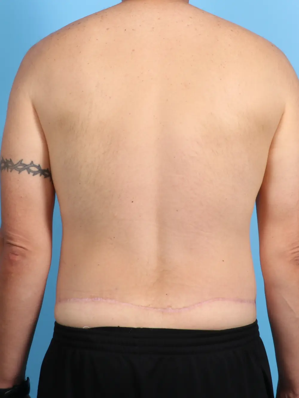 Gynecomastia Patient Photo - Case 23845 - after view-3