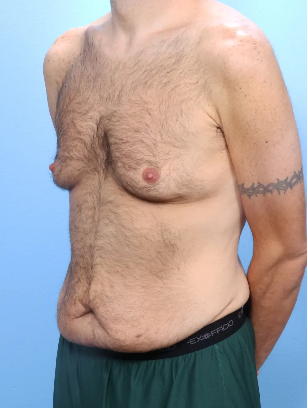 Gynecomastia Patient Photo - Case 23845 - before view-1