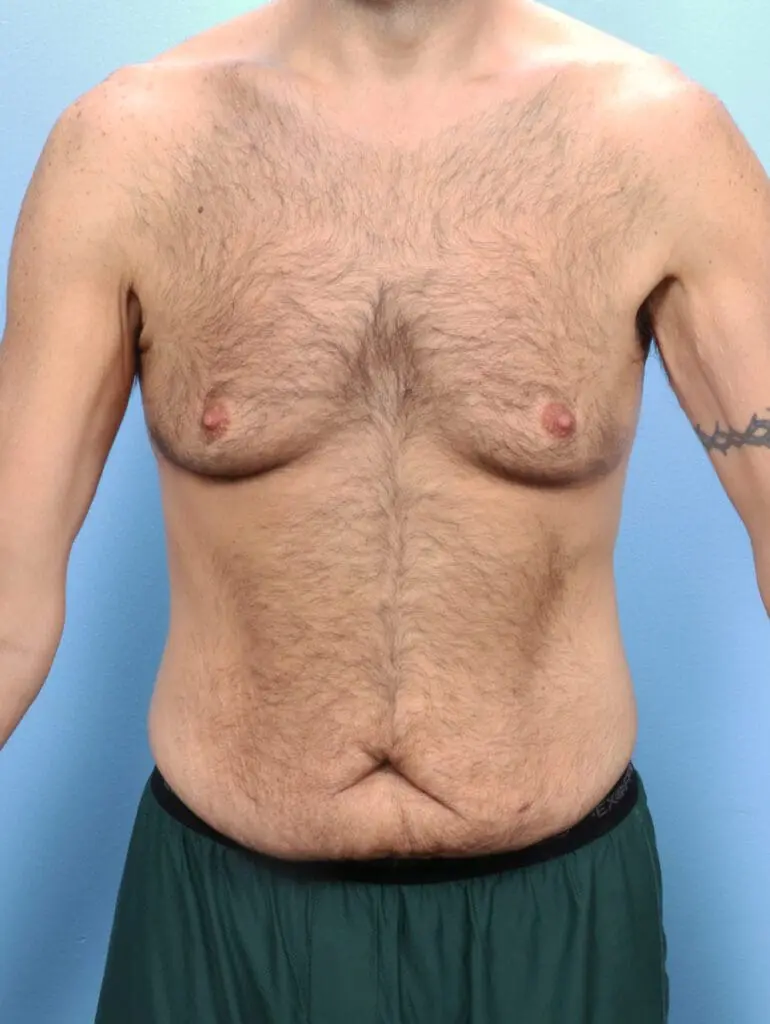 Gynecomastia - Case 23845 - Before