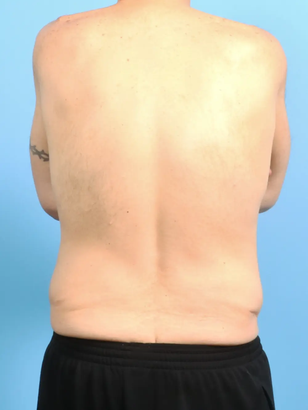 Gynecomastia Patient Photo - Case 23845 - before view-3