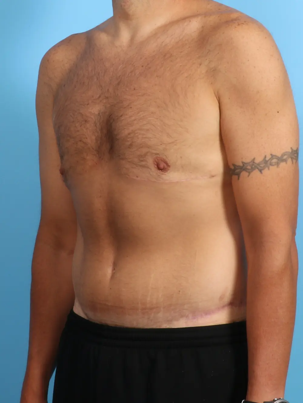 Gynecomastia Patient Photo - Case 23845 - after view-1