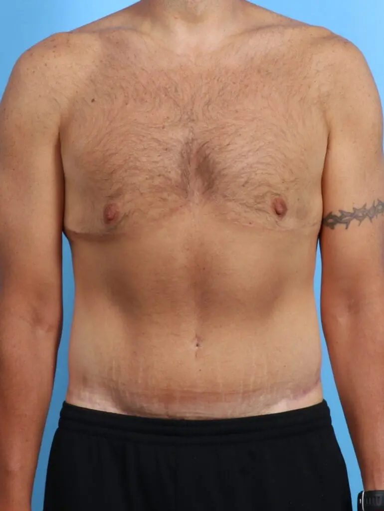 Gynecomastia - Case 23845 - After