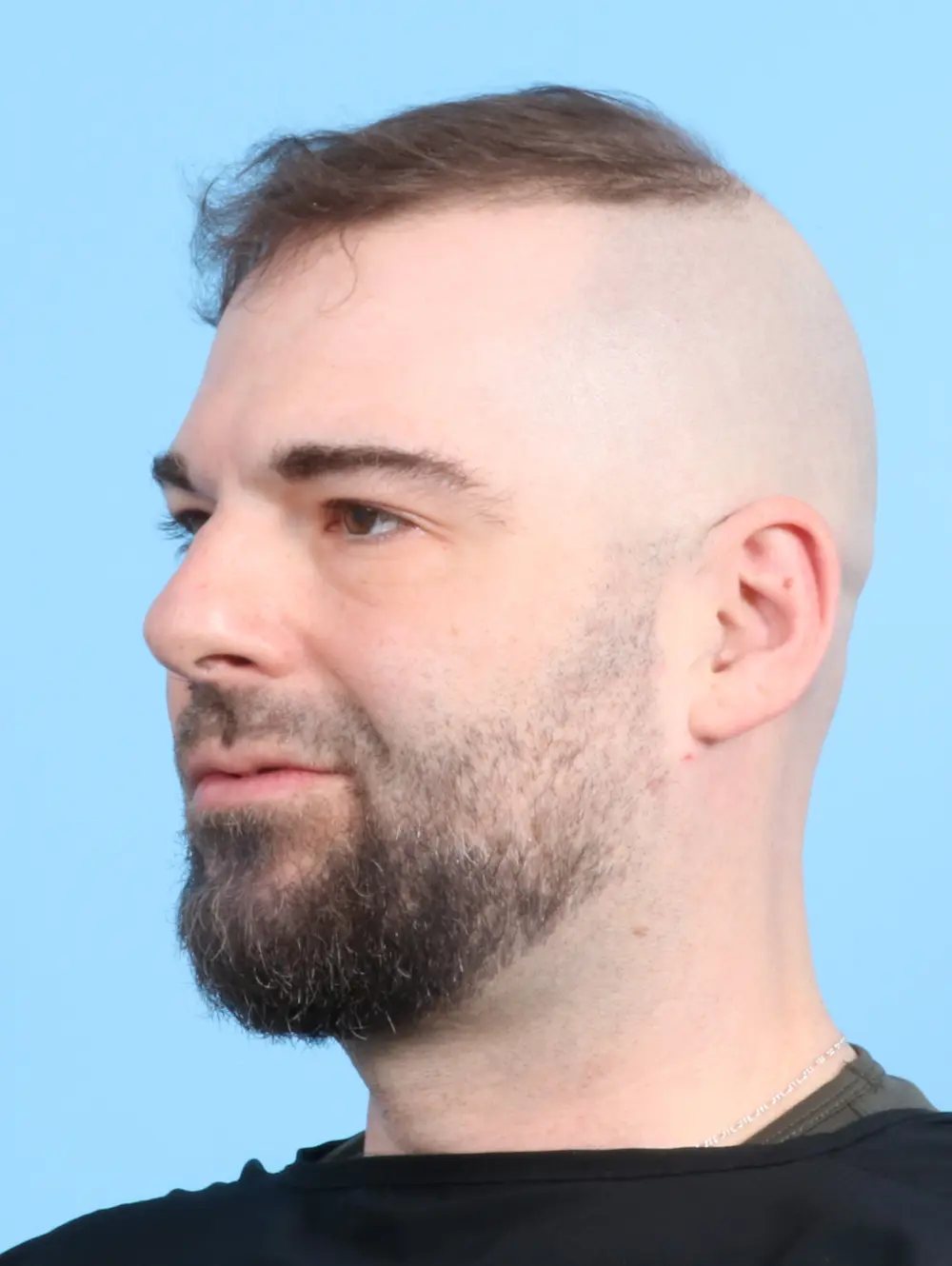Rhinoplasty Patient Photo - Case 23864 - before view-2