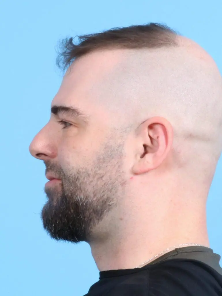 Rhinoplasty - Case 23864 - Before