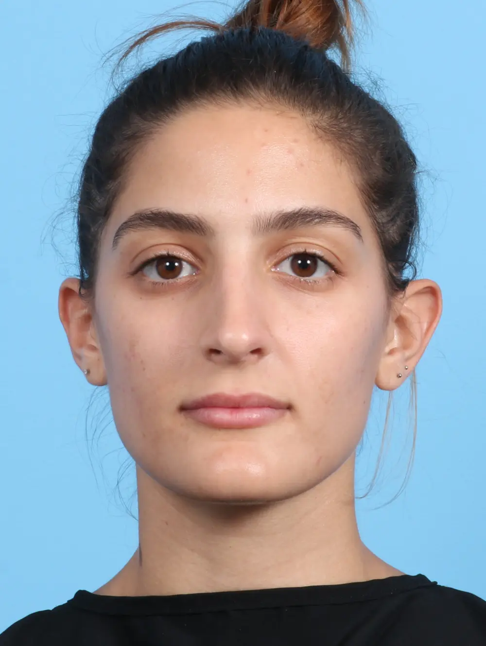 Rhinoplasty Patient Photo - Case 23872 - after view-1