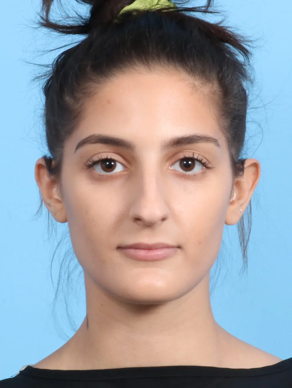 Rhinoplasty Patient Photo - Case 23872 - before view-1