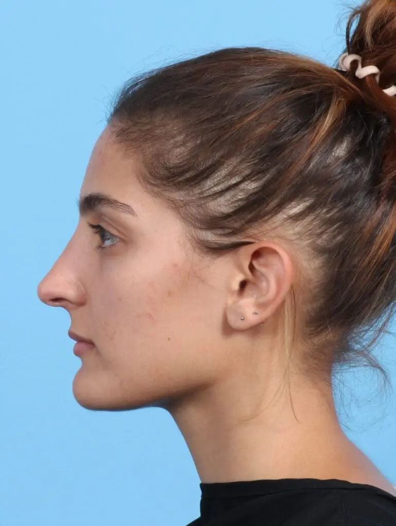 Rhinoplasty - Case 23872 - After
