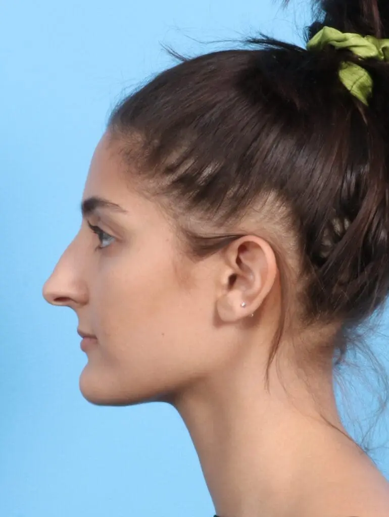 Rhinoplasty - Case 23872 - Before