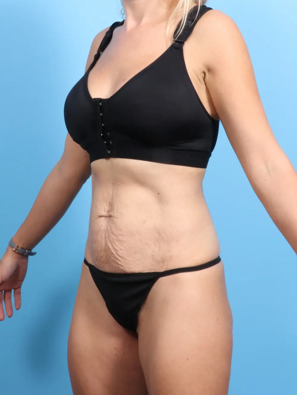Tummy Tuck Patient Photo - Case 23889 - before view-1