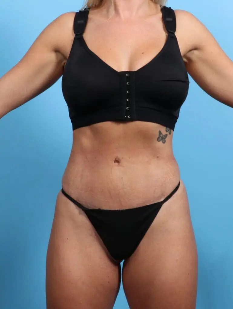 Tummy Tuck - Case 23889 - After