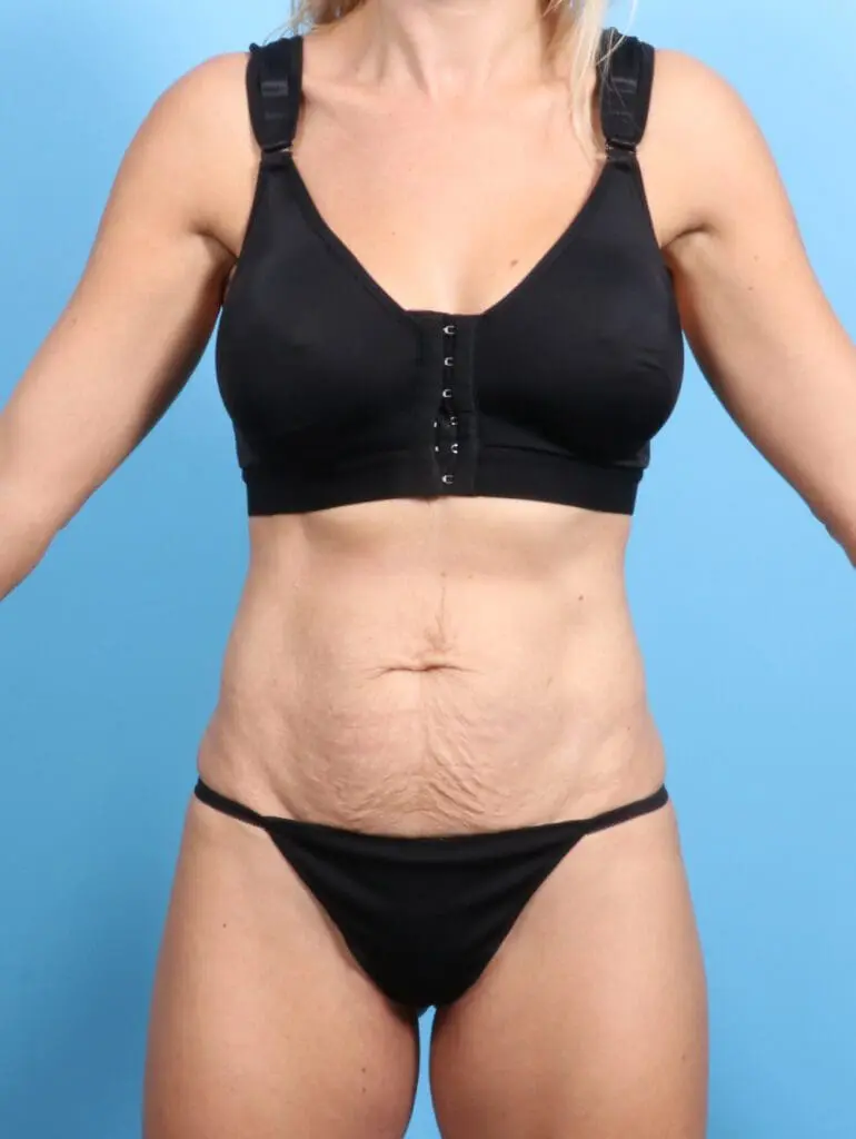 Tummy Tuck - Case 23889 - Before