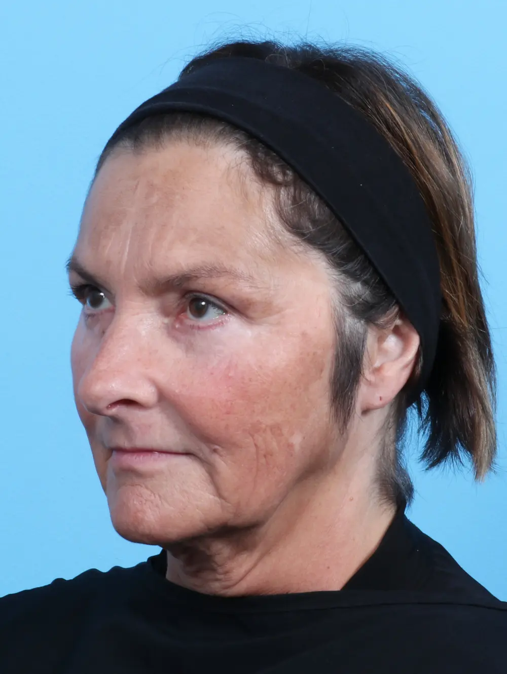 Eyelid Surgery Patient Photo - Case 23922 - after view-1