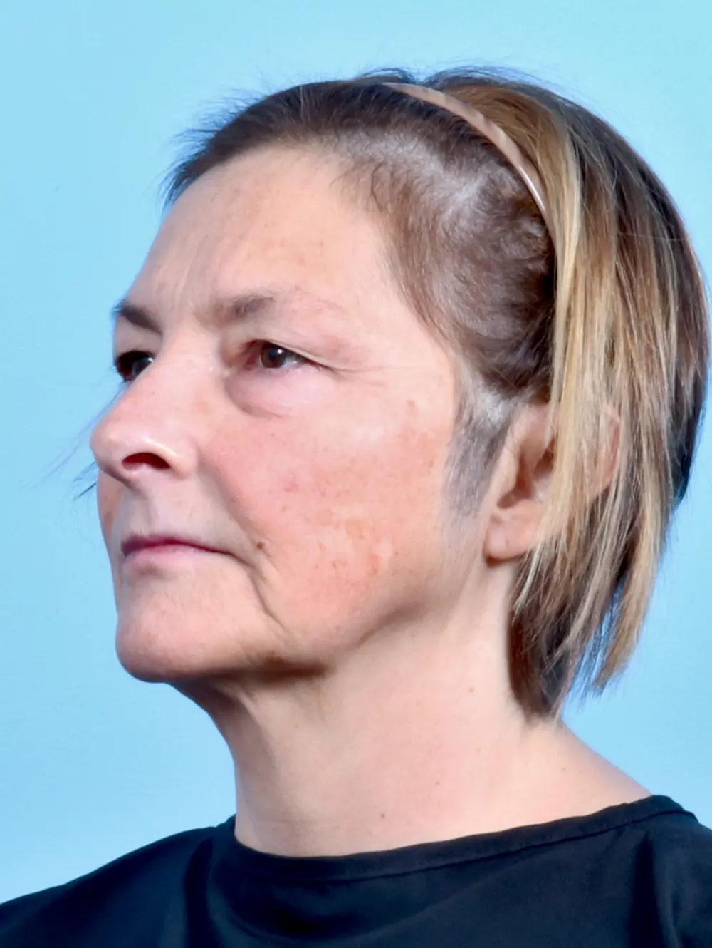 Eyelid Surgery Patient Photo - Case 23922 - before view-1