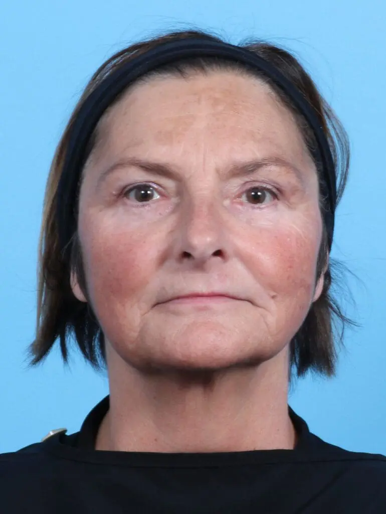 Eyelid Surgery - Case 23922 - After