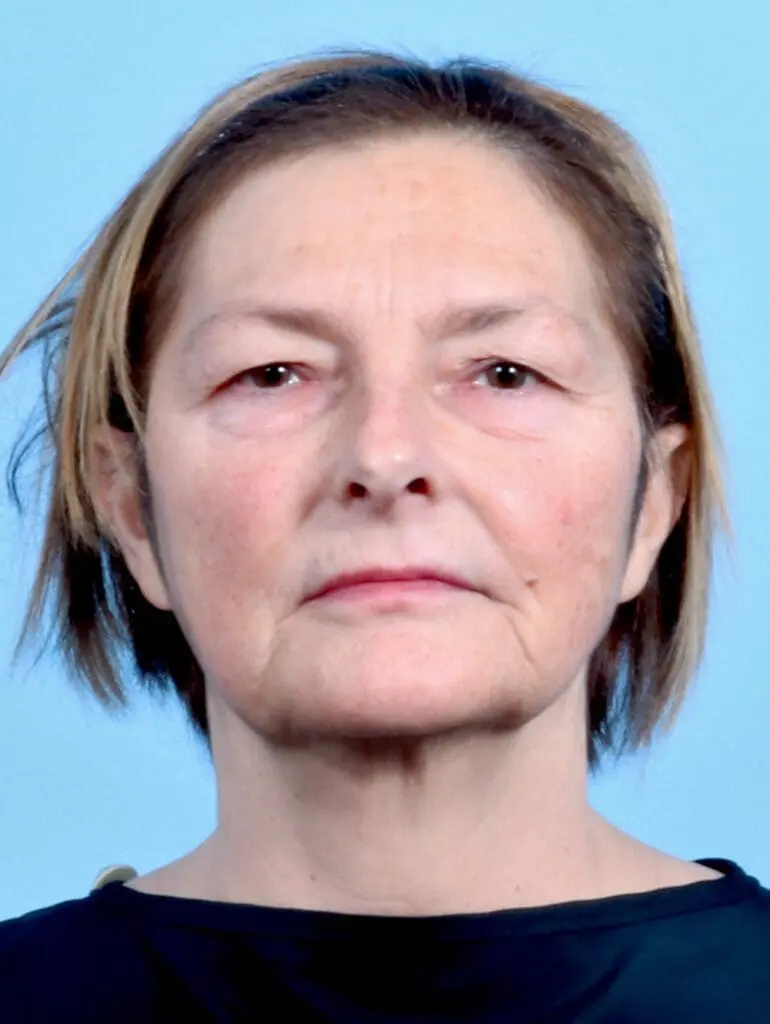 Eyelid Surgery - Case 23922 - Before