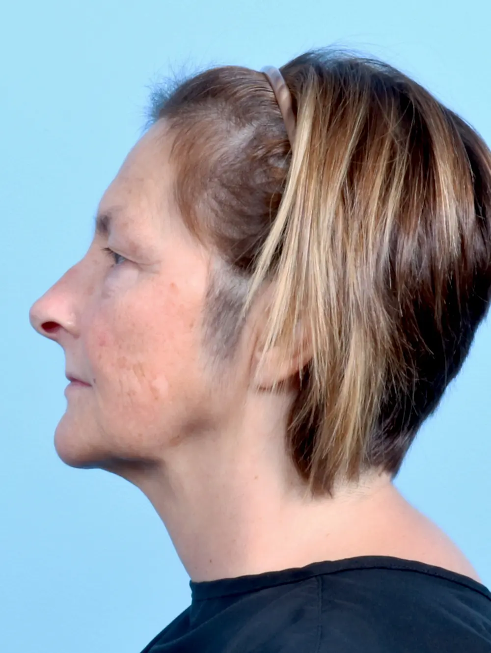 Eyelid Surgery Patient Photo - Case 23922 - before view-2