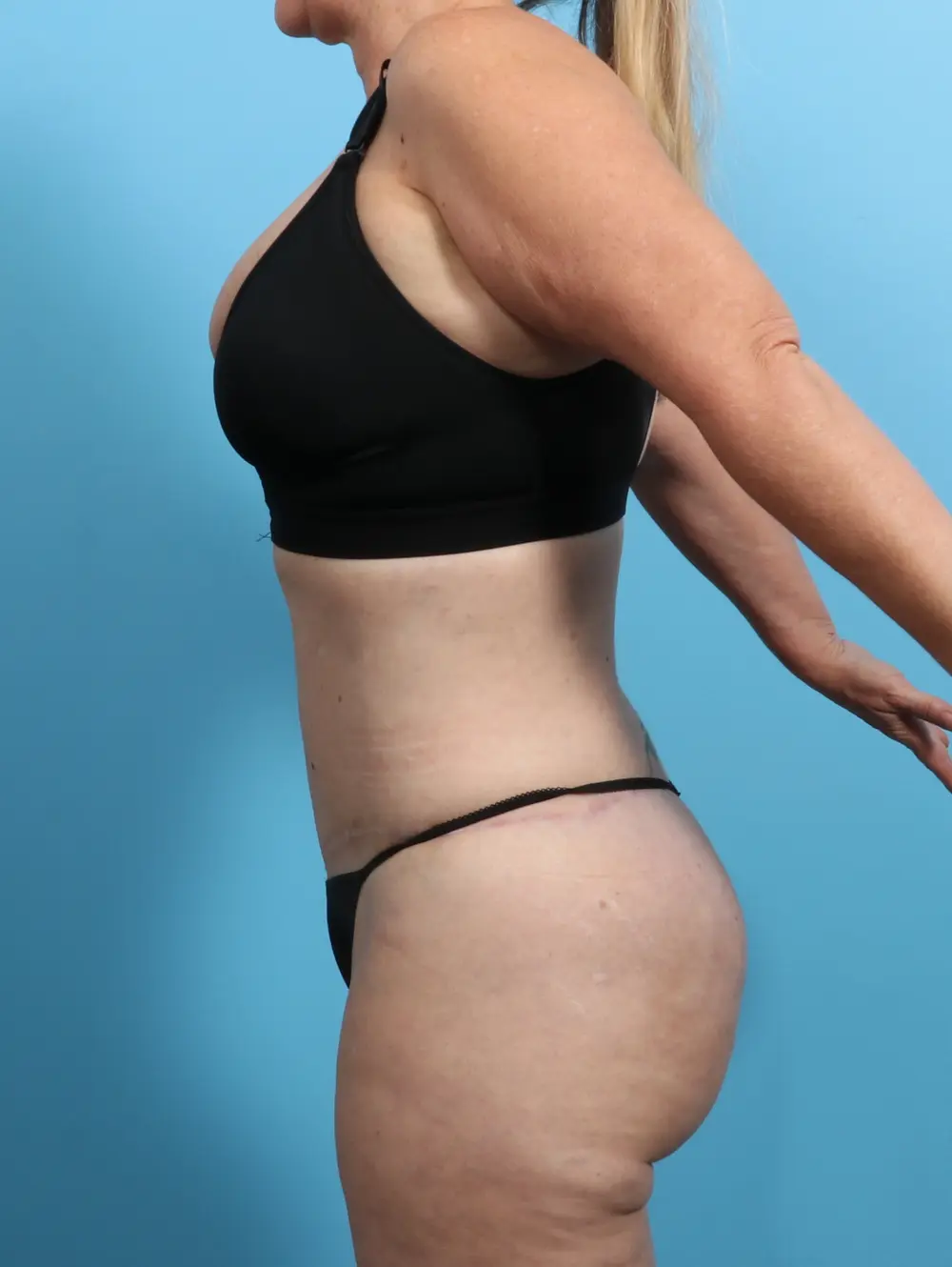 Brazilian Butt Lift Patient Photo - Case 23930 - after view-1