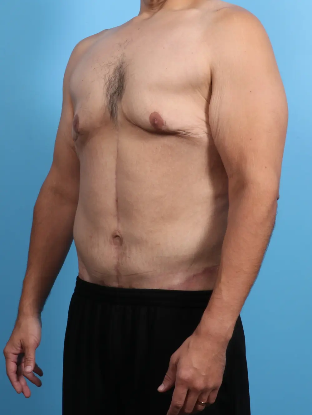 After Weight Loss Patient Photo - Case 23944 - after view-1