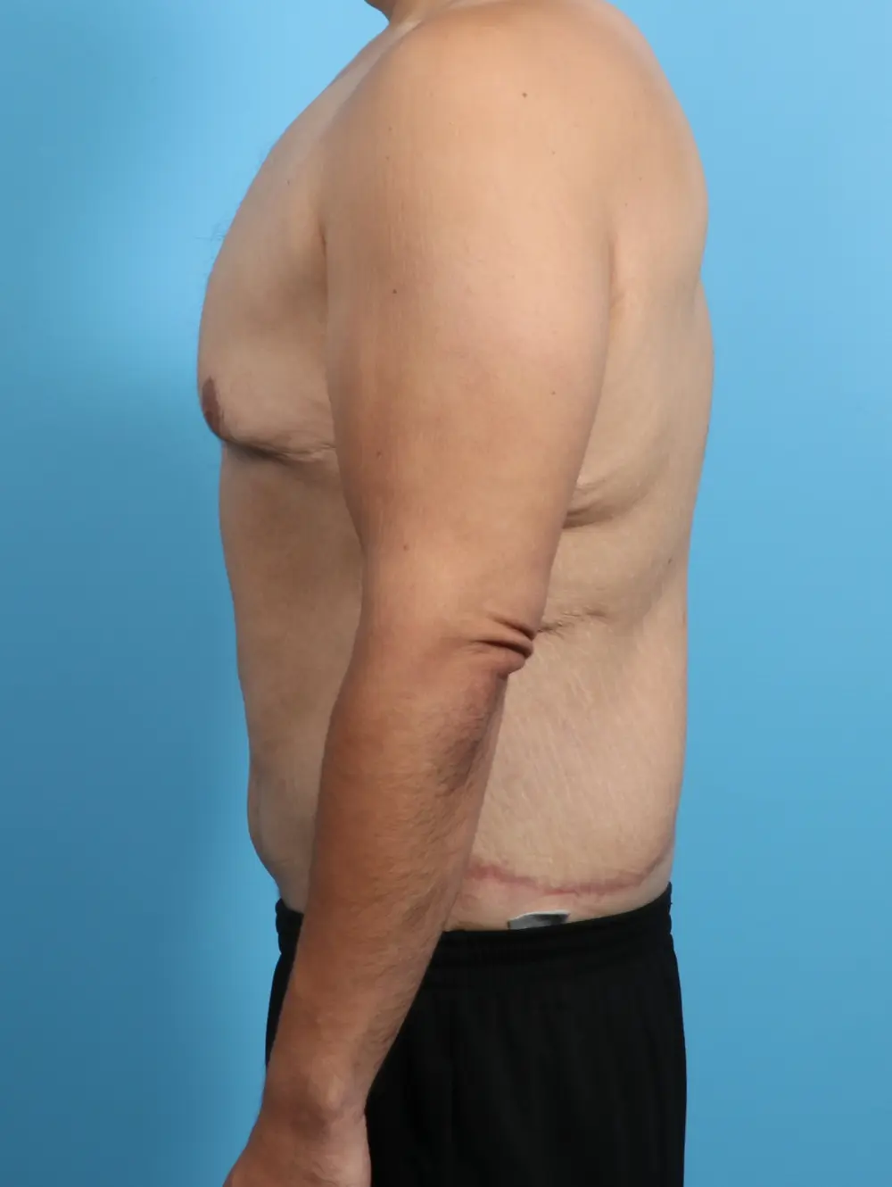 After Weight Loss Patient Photo - Case 23944 - after view-2