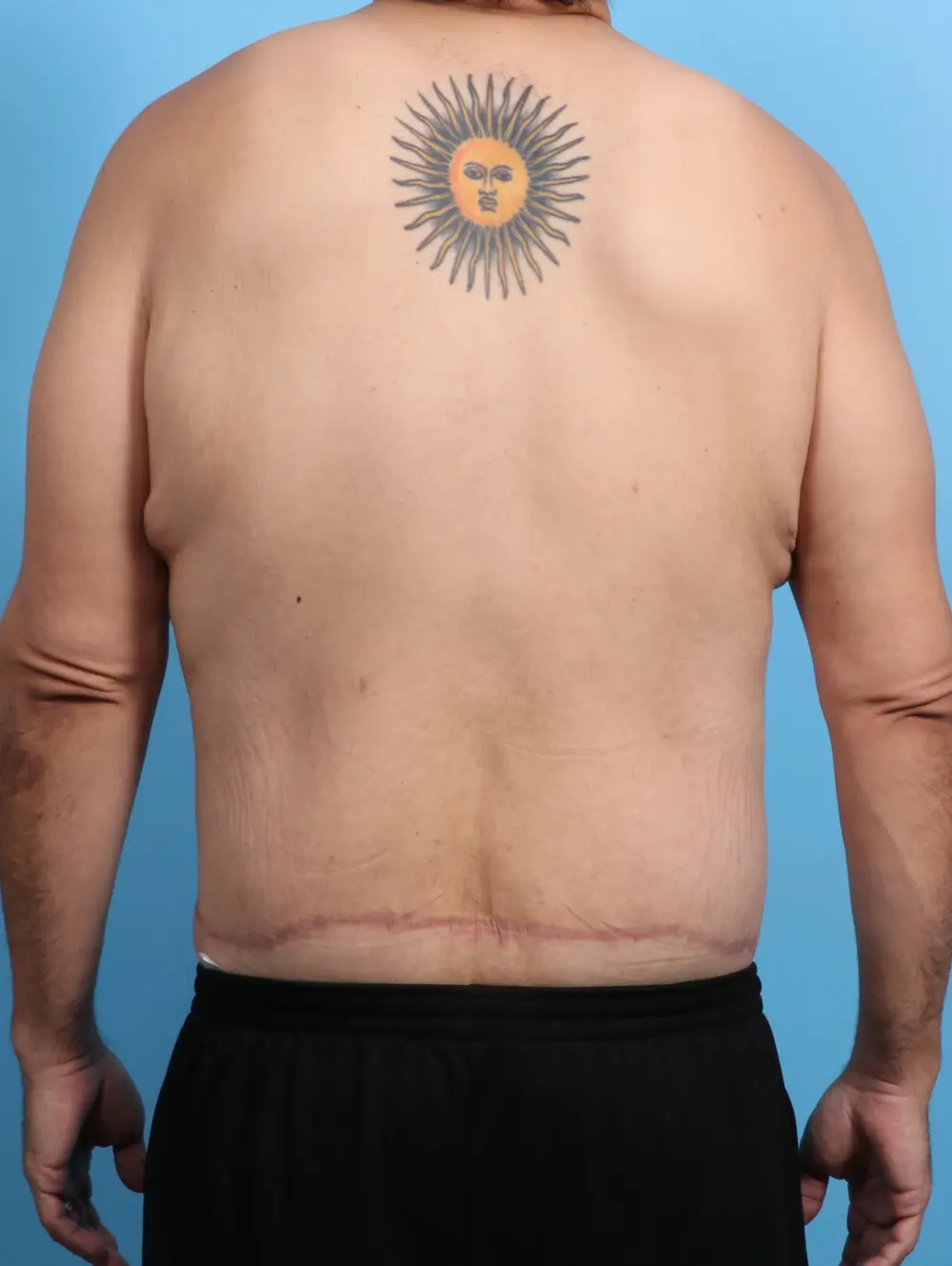 After Weight Loss Patient Photo - Case 23944 - after view-3