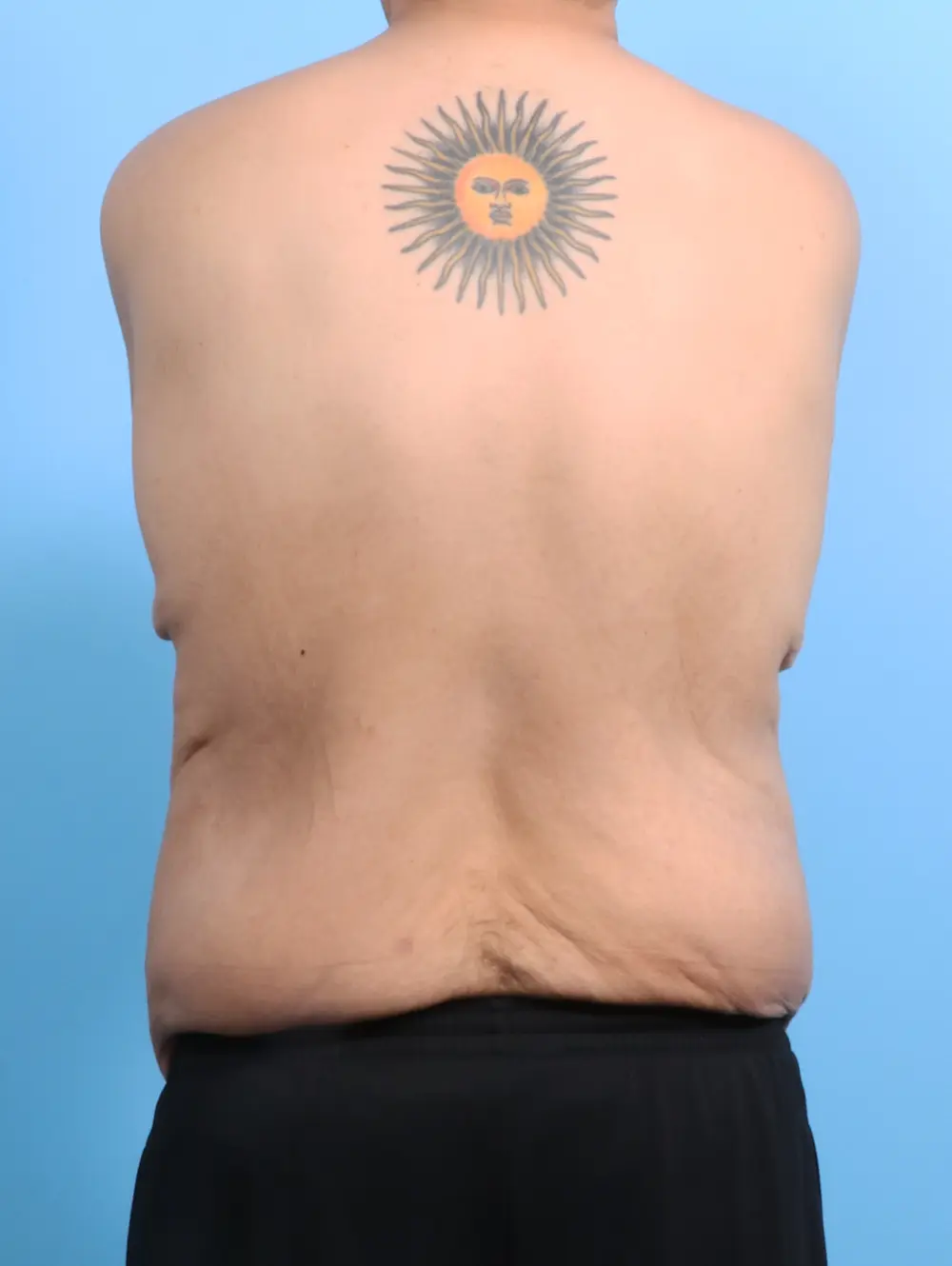 After Weight Loss Patient Photo - Case 23944 - before view-3