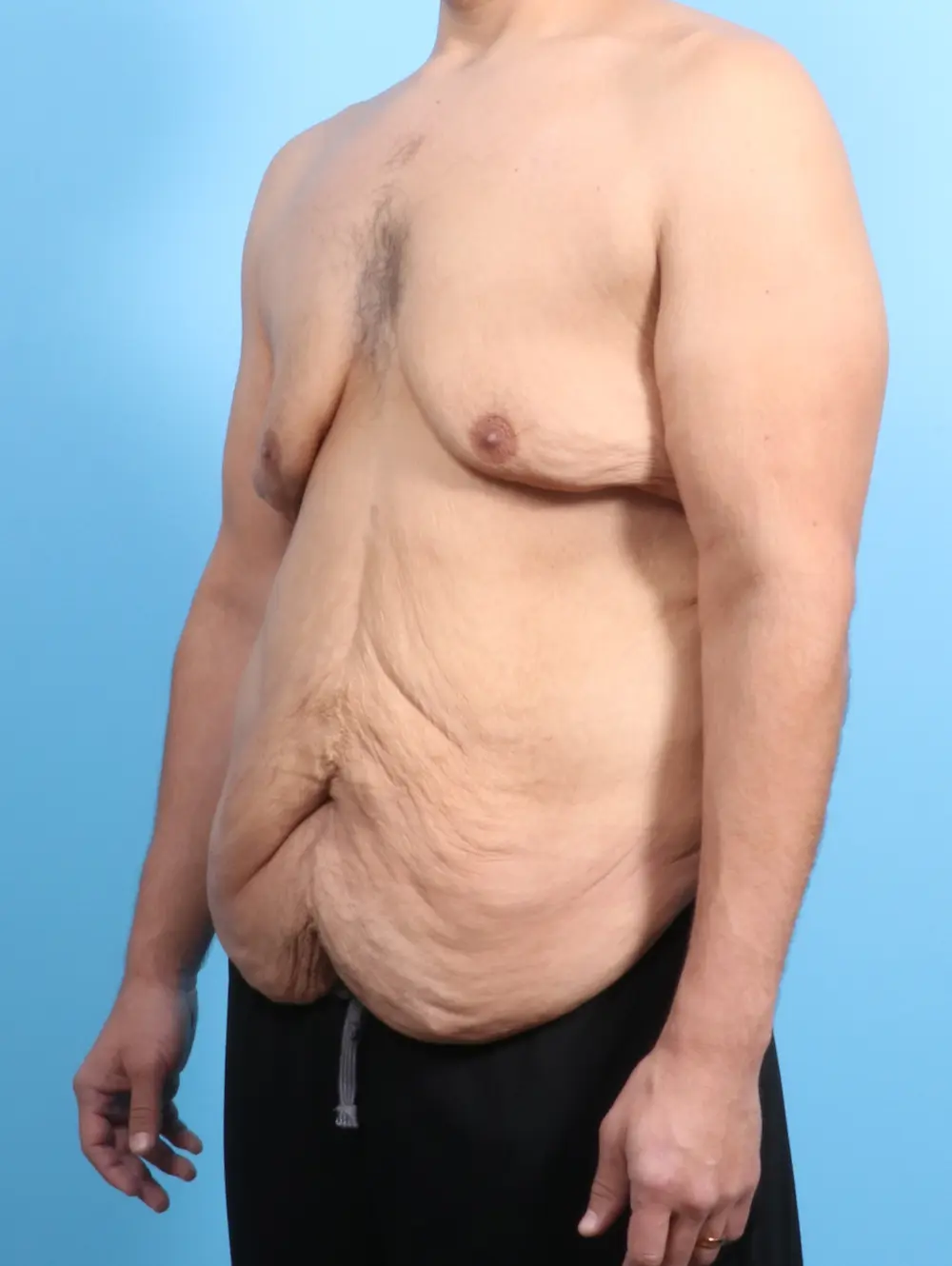 After Weight Loss Patient Photo - Case 23944 - before view-1