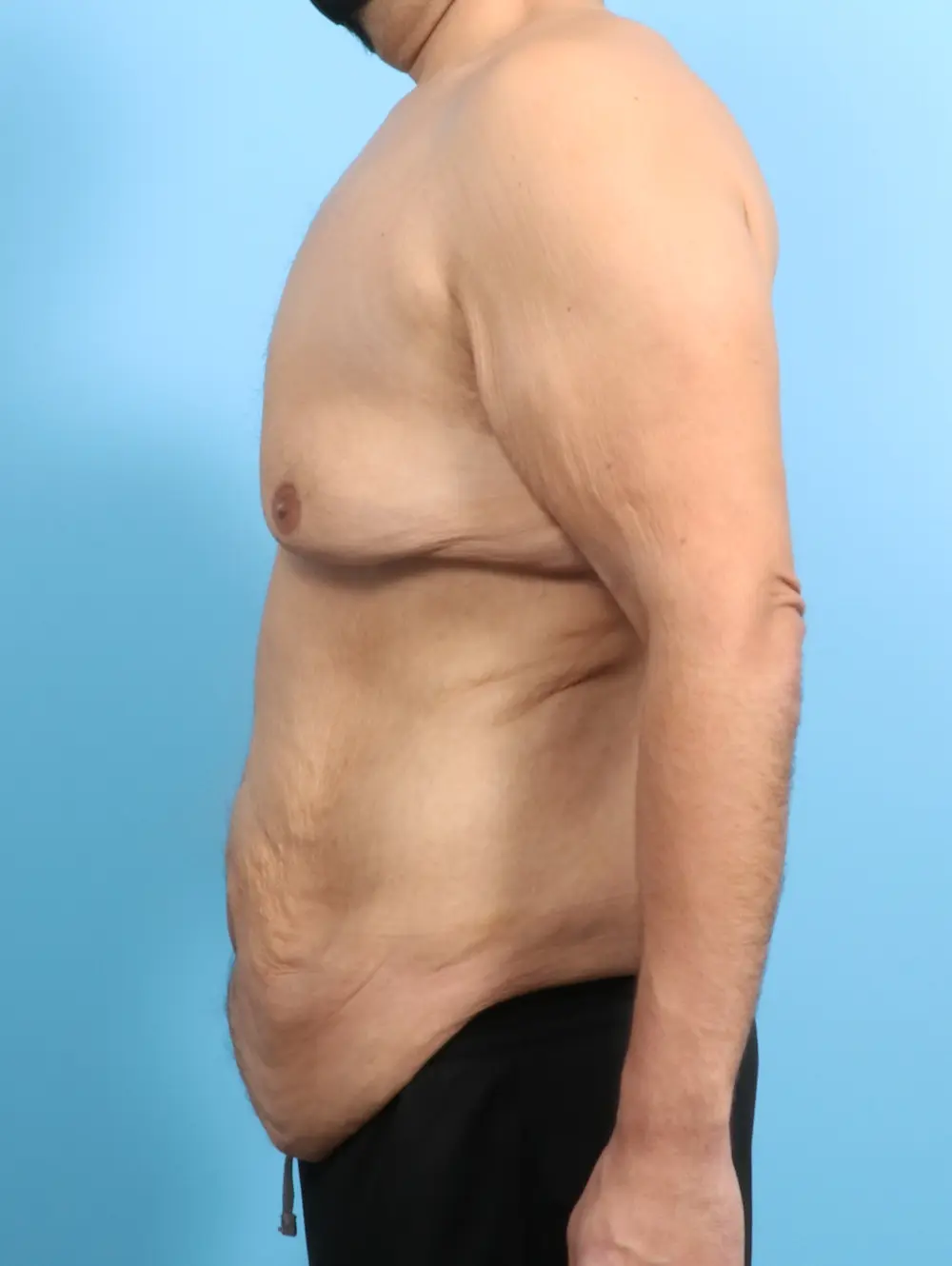 After Weight Loss Patient Photo - Case 23944 - before view-2