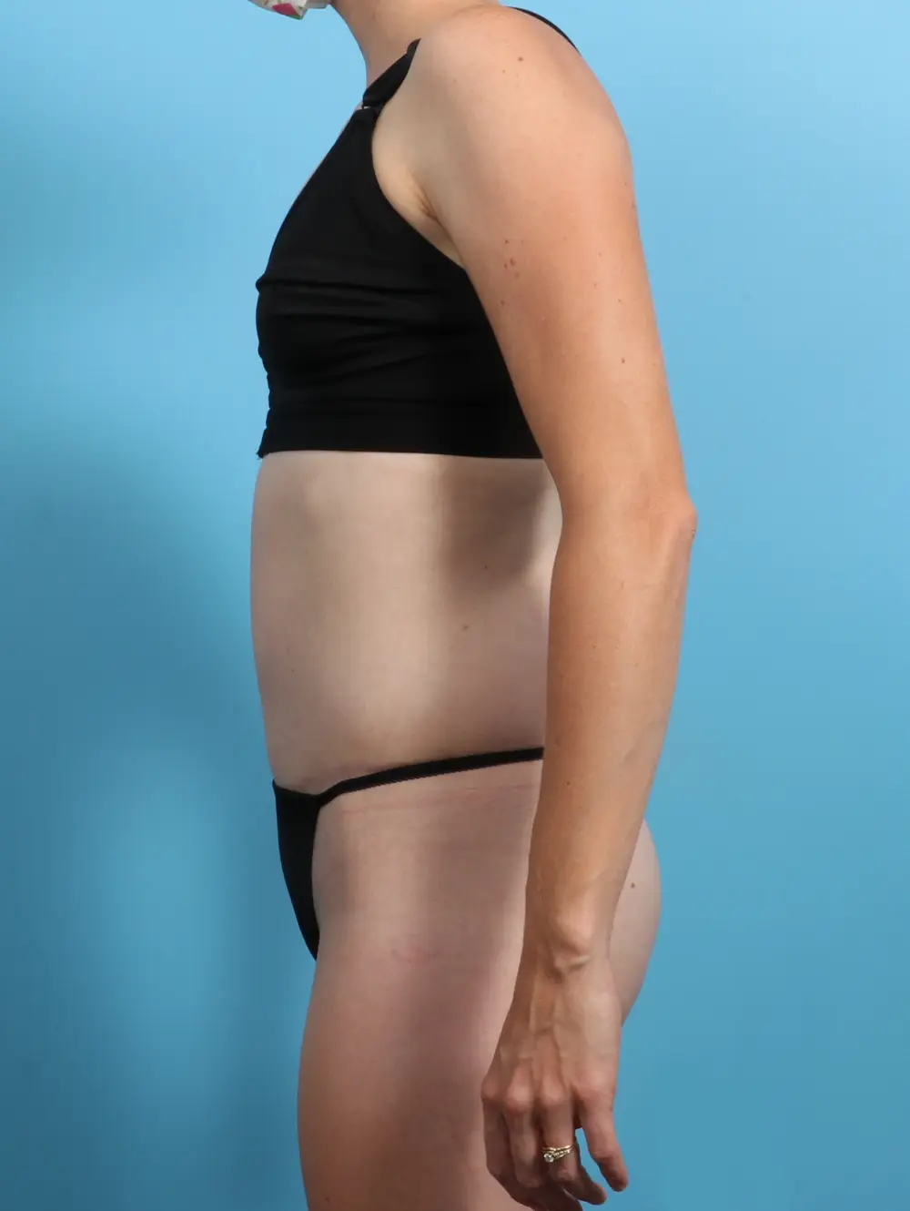 Tummy Tuck Patient Photo - Case 23954 - after view-2