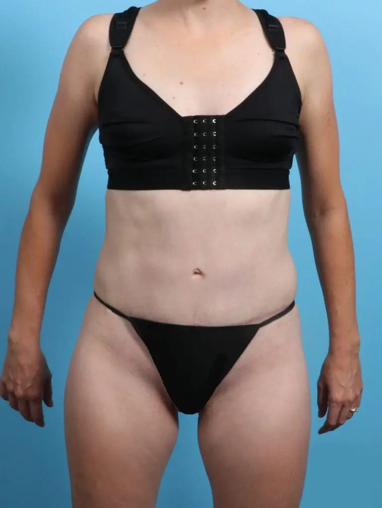 Tummy Tuck - Case 23954 - After