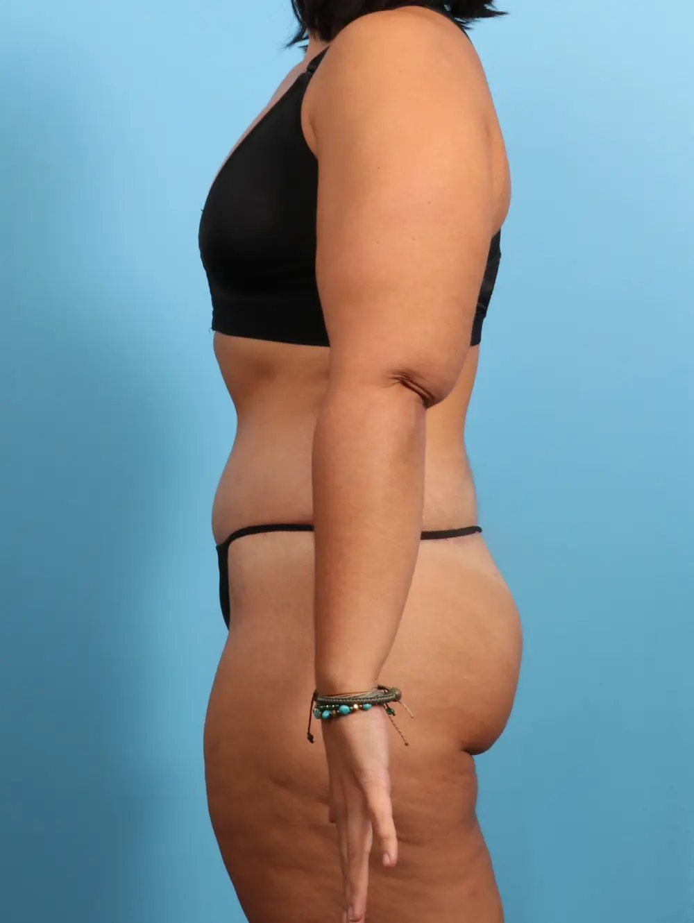 After Weight Loss Patient Photo - Case 24102 - after view-2