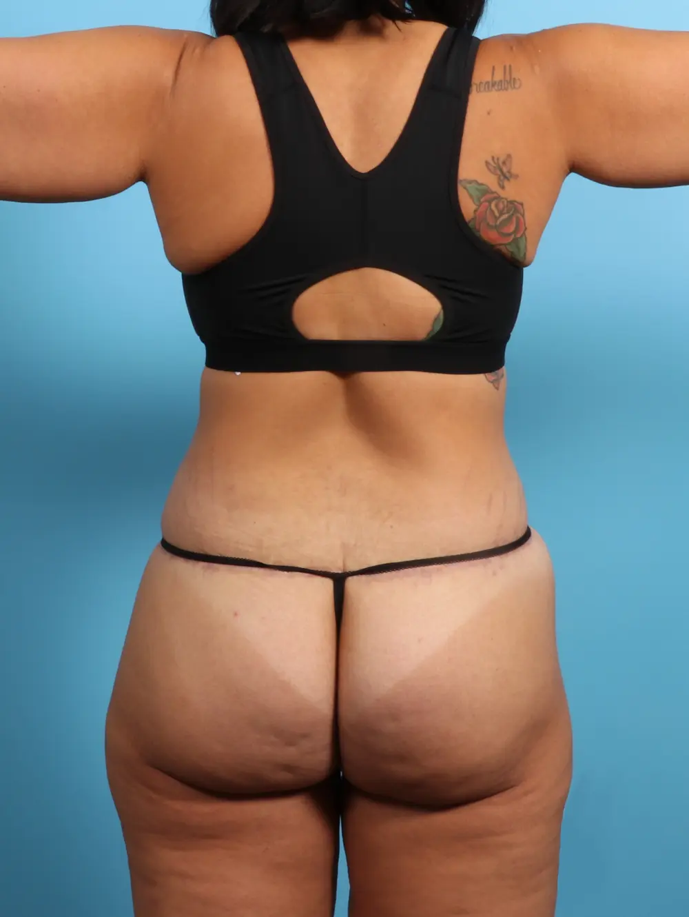 After Weight Loss Patient Photo - Case 24102 - after view-3