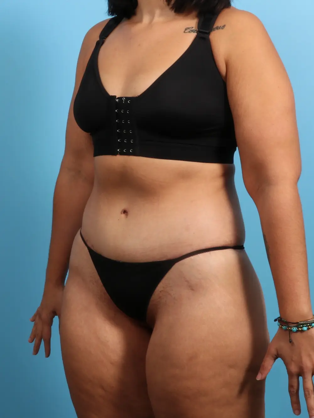 After Weight Loss Patient Photo - Case 24102 - after view-1