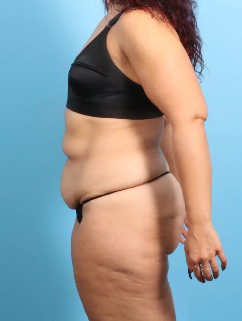 After Weight Loss Patient Photo - Case 24102 - before view-2