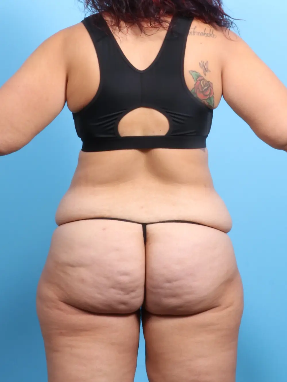After Weight Loss Patient Photo - Case 24102 - before view-3