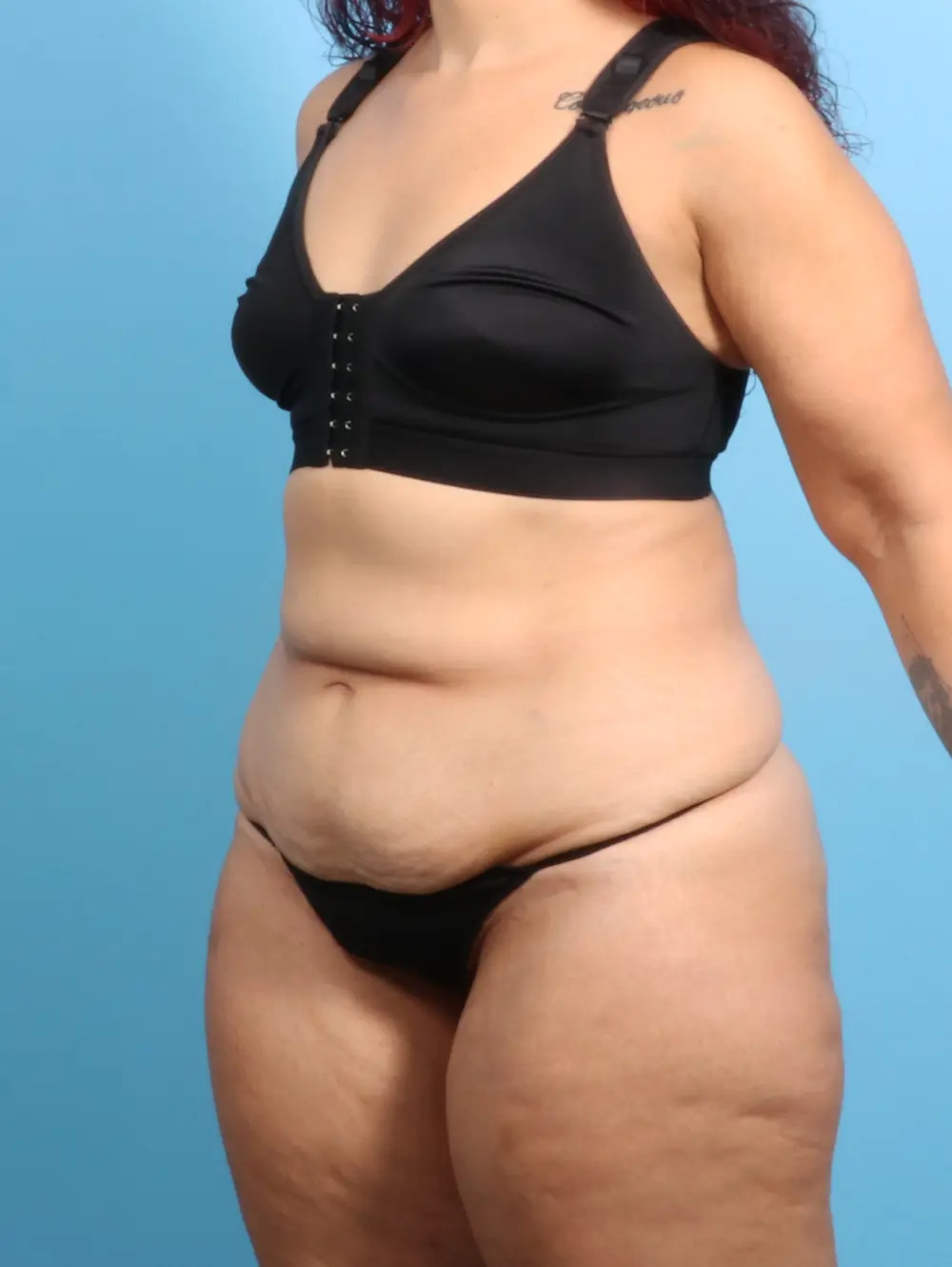 After Weight Loss Patient Photo - Case 24102 - before view-1