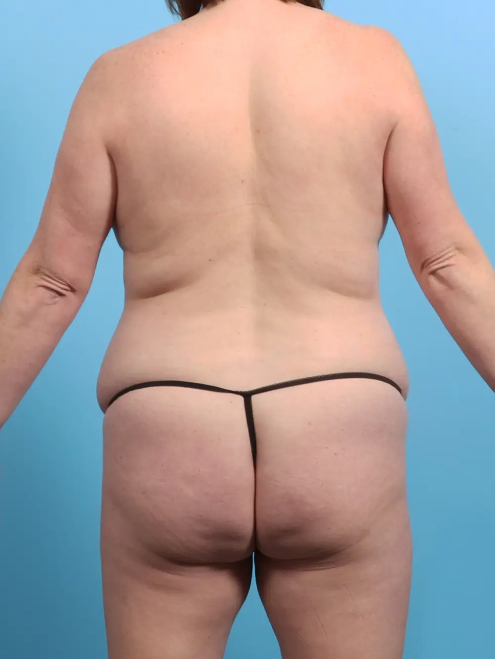 Tummy Tuck Patient Photo - Case 24145 - before view-3