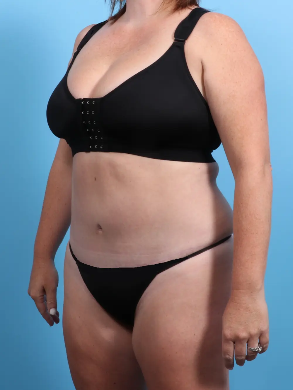Tummy Tuck Patient Photo - Case 24145 - after view-1