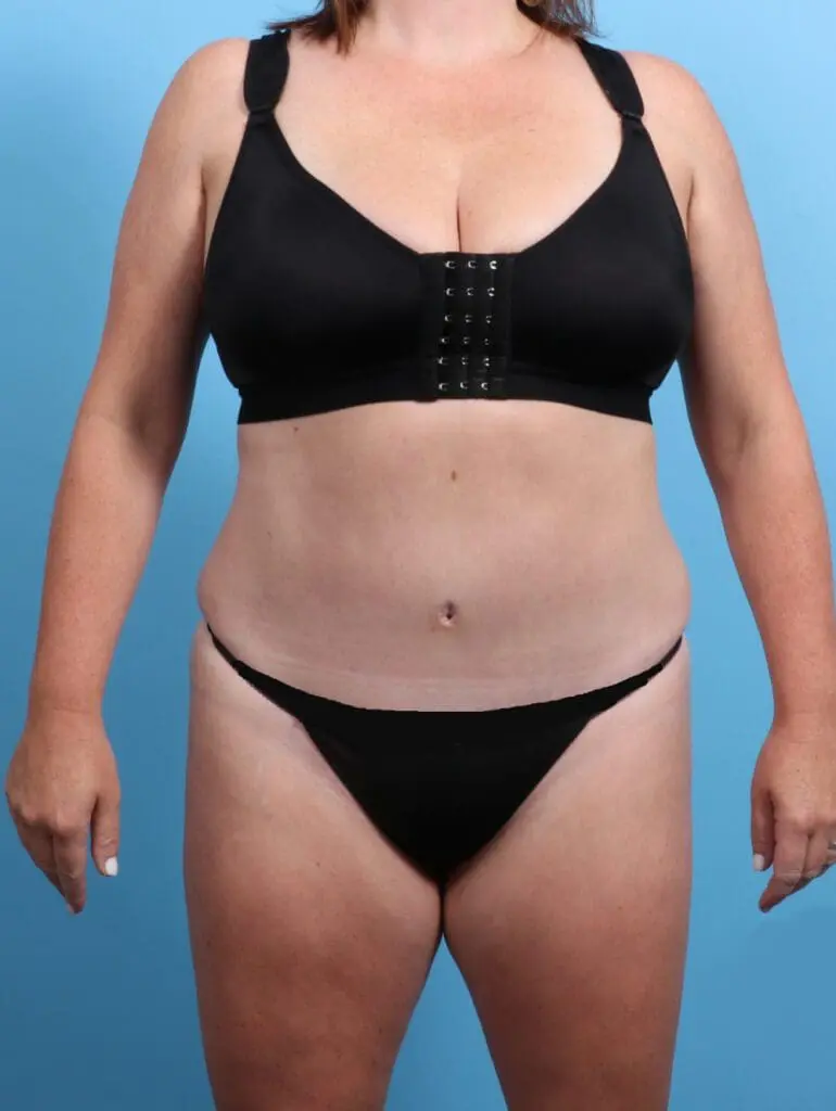 Tummy Tuck - Case 24145 - After