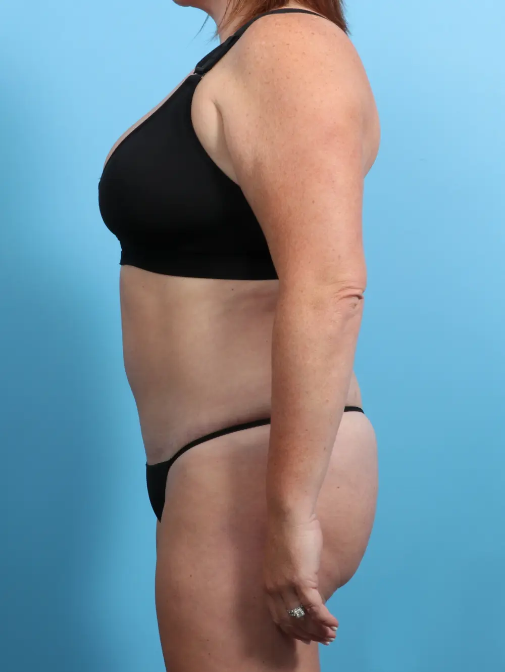 Tummy Tuck Patient Photo - Case 24145 - after view-2