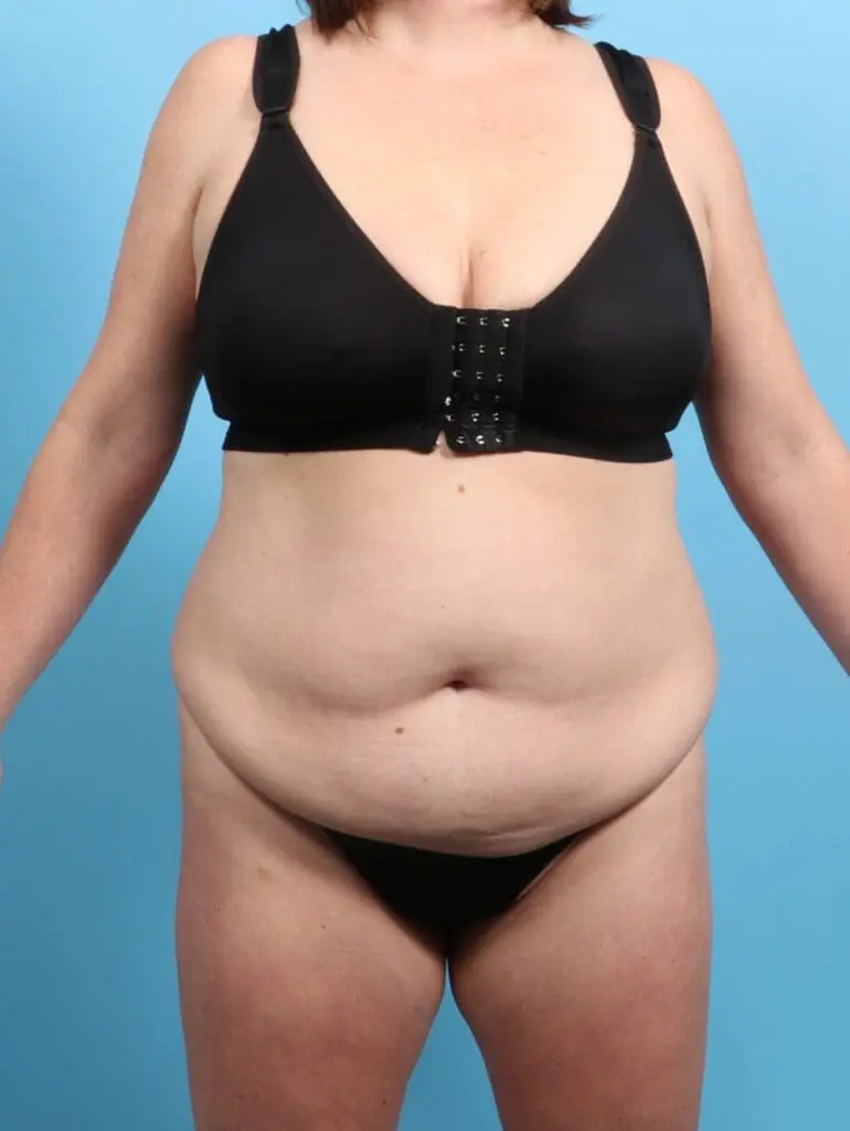 Tummy Tuck - Case 24145 - Before