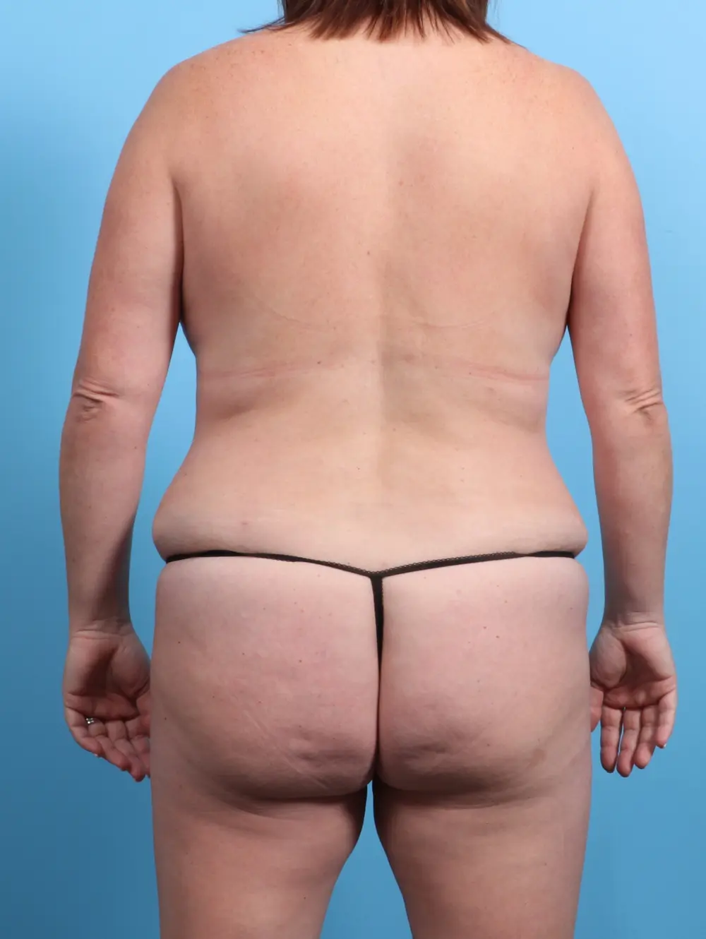 Tummy Tuck Patient Photo - Case 24145 - after view-3