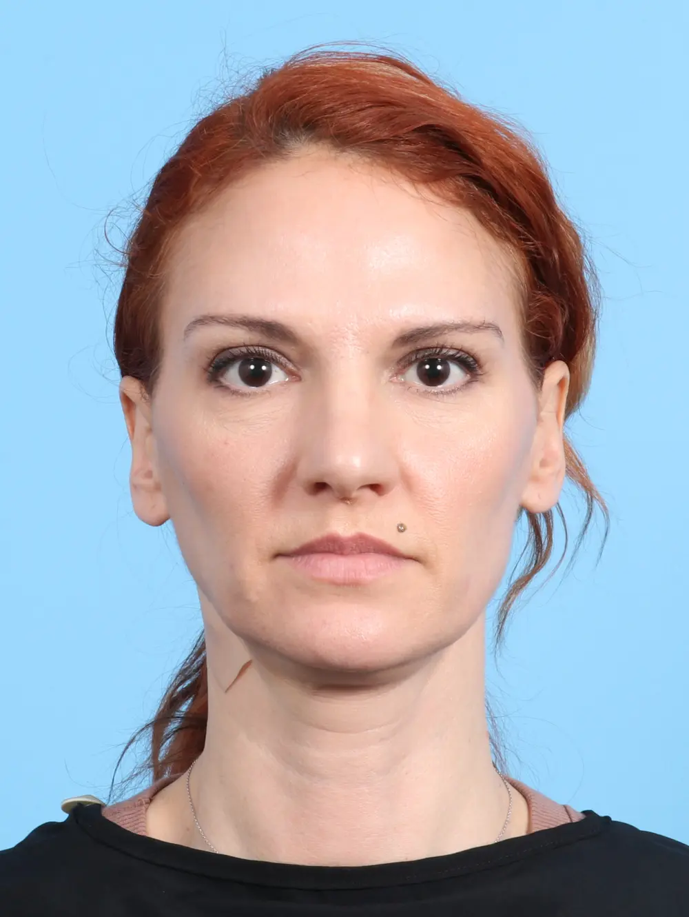 Rhinoplasty Patient Photo - Case 24155 - before view-2