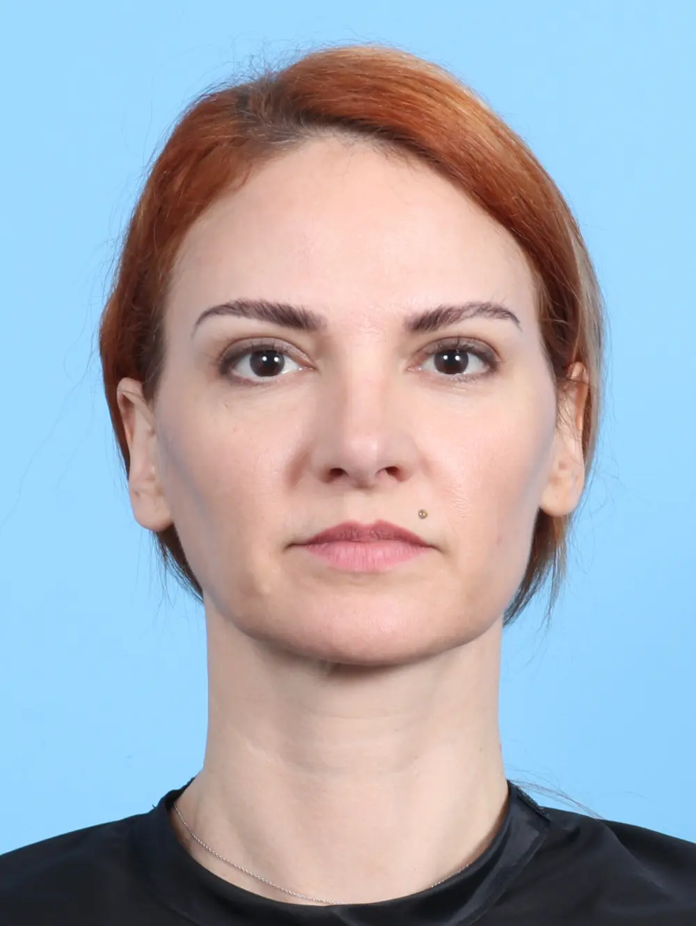 Rhinoplasty Patient Photo - Case 24155 - after view-2