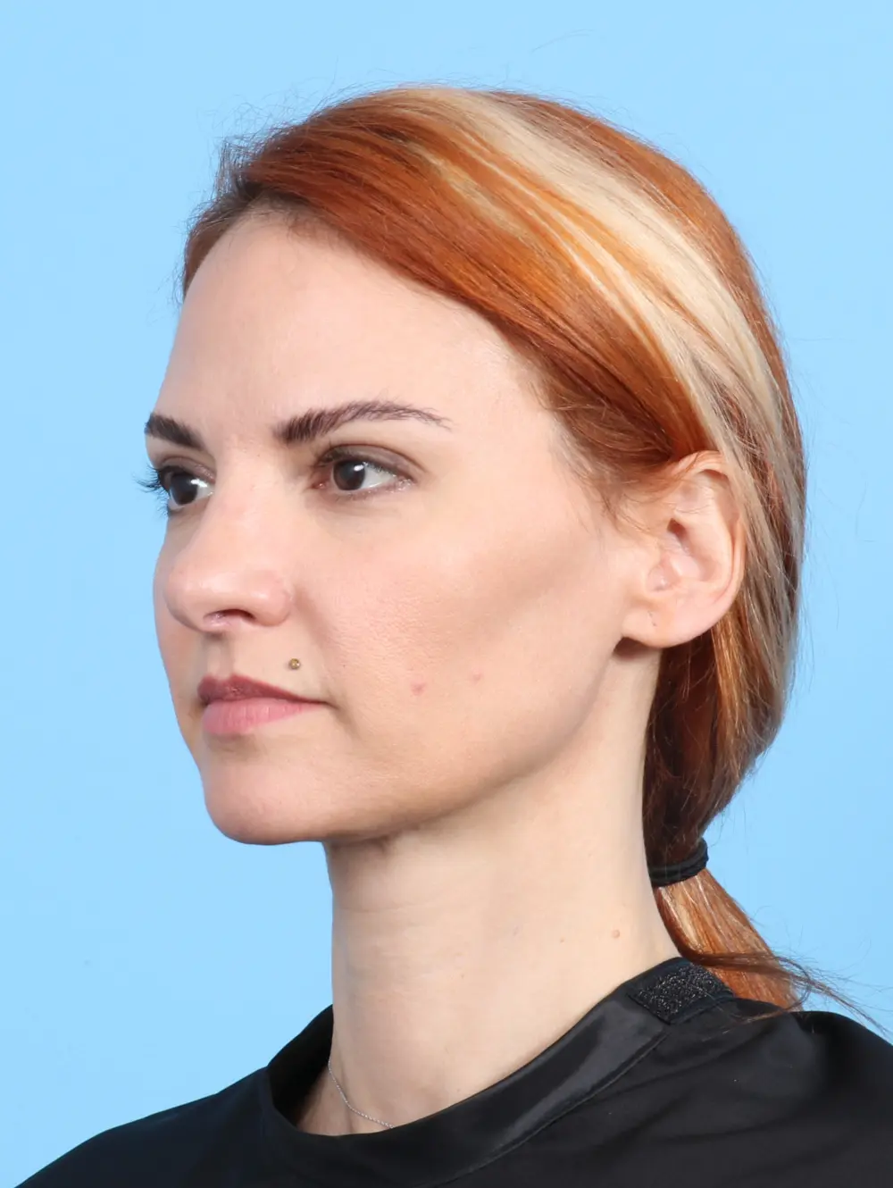 Rhinoplasty Patient Photo - Case 24155 - after view-1