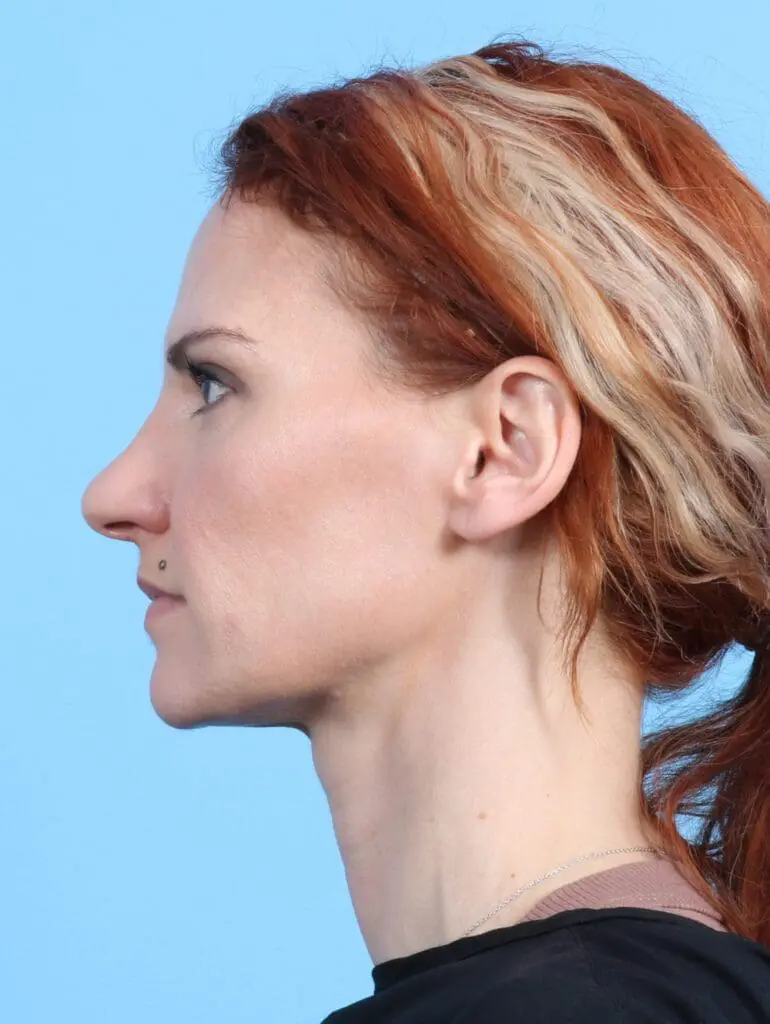 Rhinoplasty - Case 24155 - Before