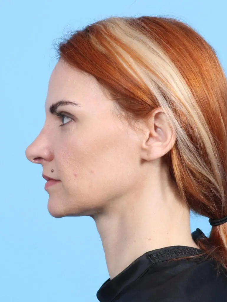 Rhinoplasty - Case 24155 - After